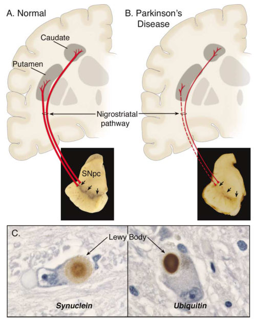 帕金森的病理学示意图