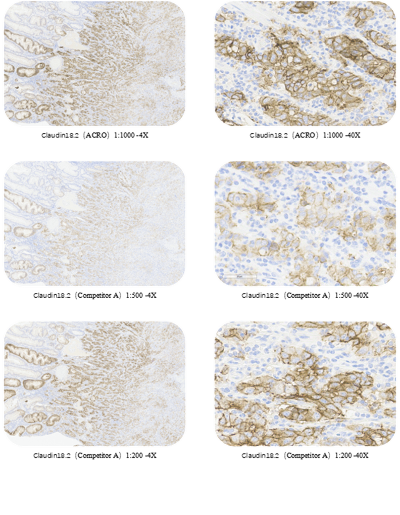 Claudin18.2胃癌组织染色