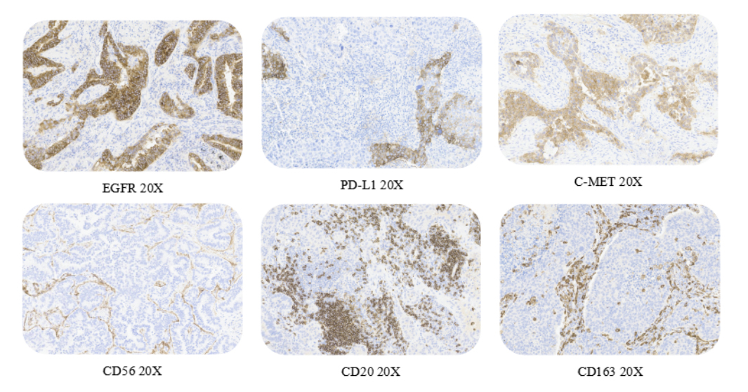 肺癌组织染色示例